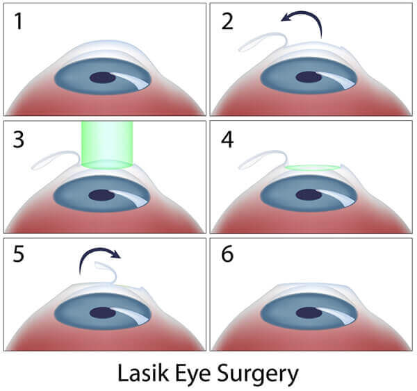 LASIK steps diagram