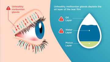 Diagram showing how unhealthy meibomian glands deplete the oil layer of the tear film