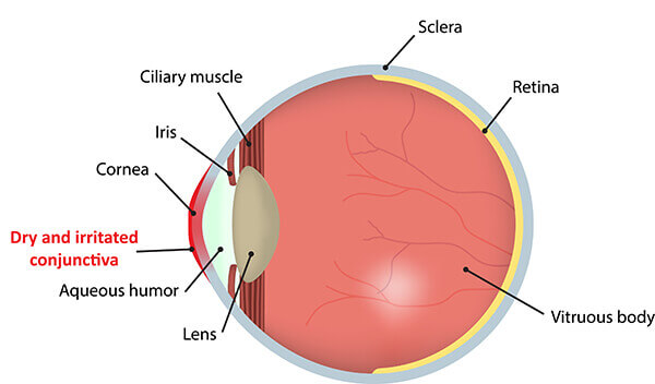 Dry Eye Diagram