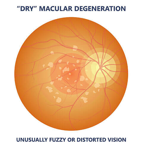 Dry Macular Degeneration