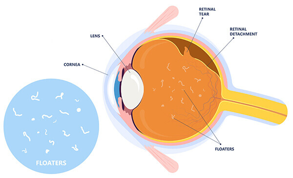 Dry eyes and floaters: Causes, treatment, and seeking help