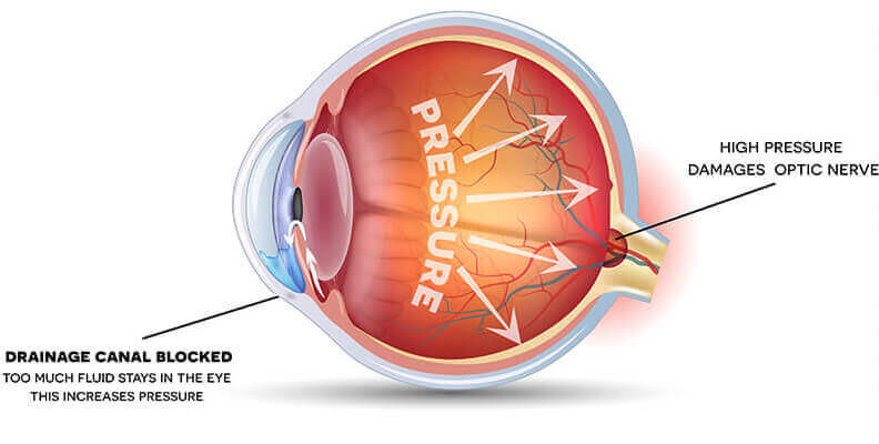 Glaucoma Diagram