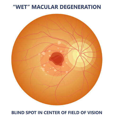 Wet macular degeneration